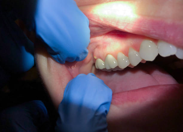 Best Broken or Cracked Tooth Emergency Dentist in Sewanee, TN