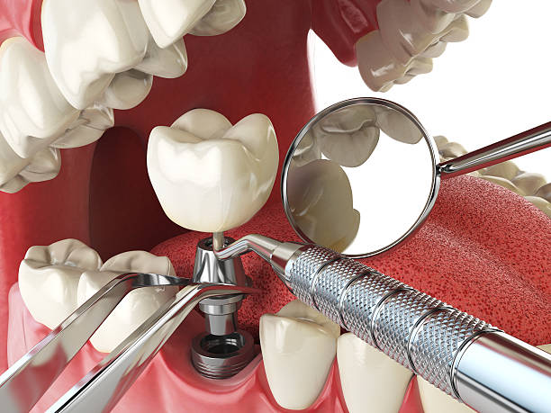 Best Emergency Dental Extractions in Sewanee, TN